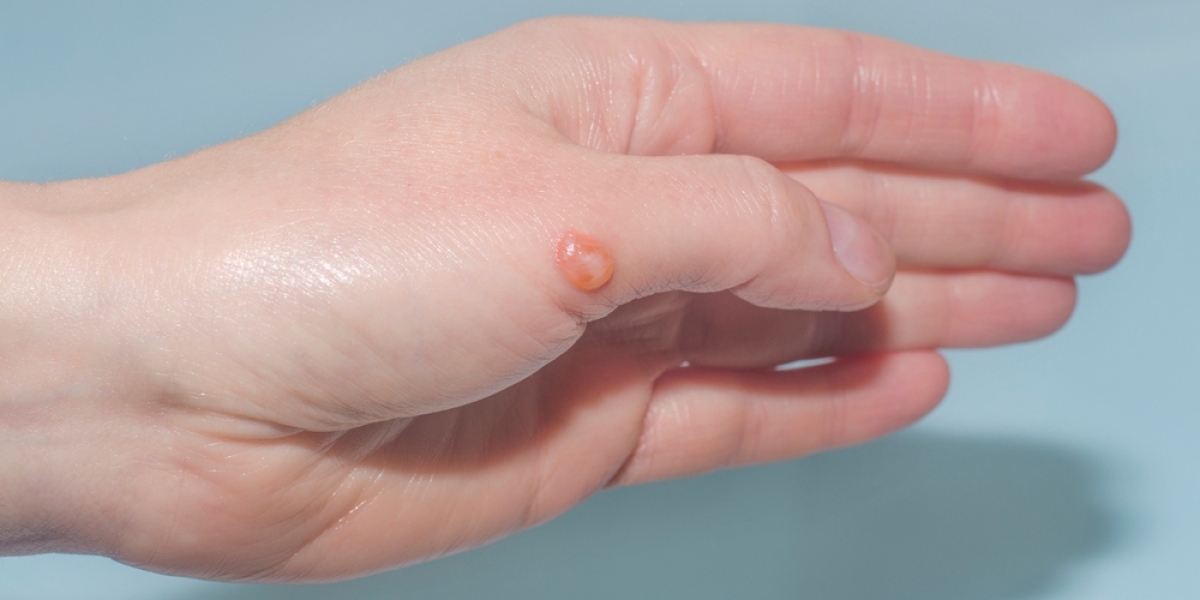 Blisterata Unveiled: Decoding the Facts Behind the Buzz