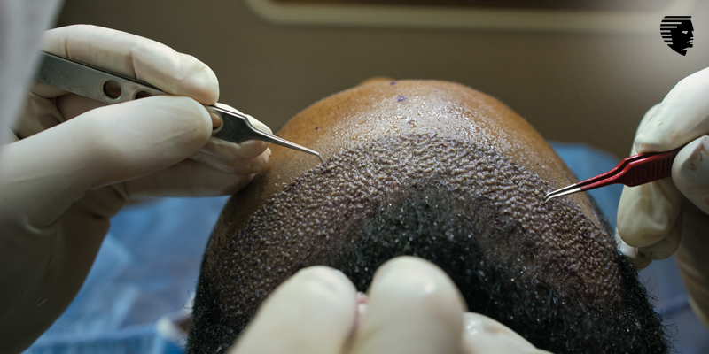 Hair Transplant in Dubai